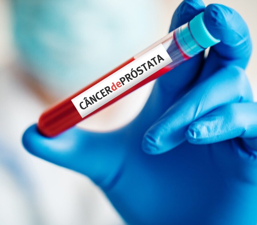 Diagnóstico e rastreamento do Câncer de próstata